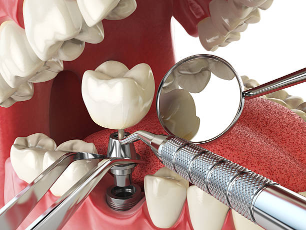 Best Emergency Wisdom Tooth Extraction in Melville, RI